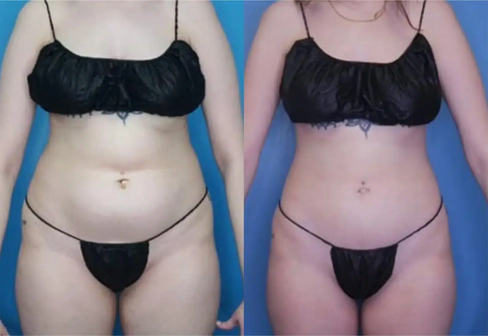Before and After Image: Vaser Liposuction - front