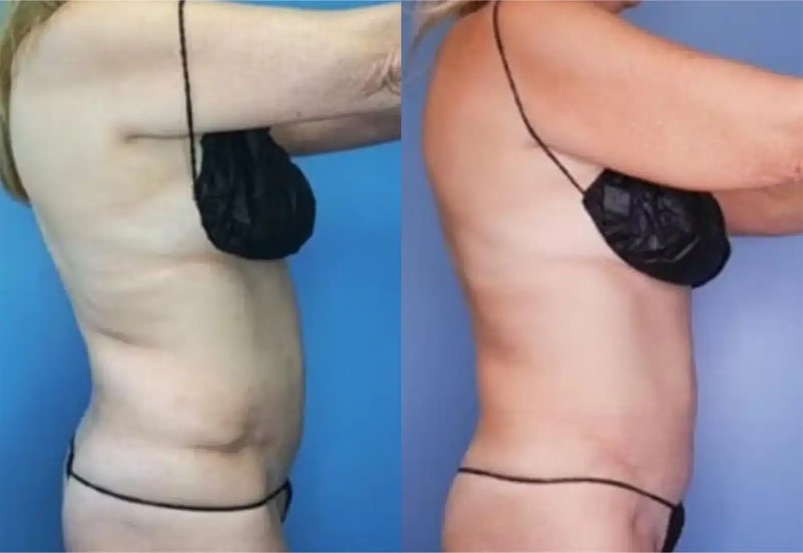 Before and After Image: Vaser Liposuction - right-side