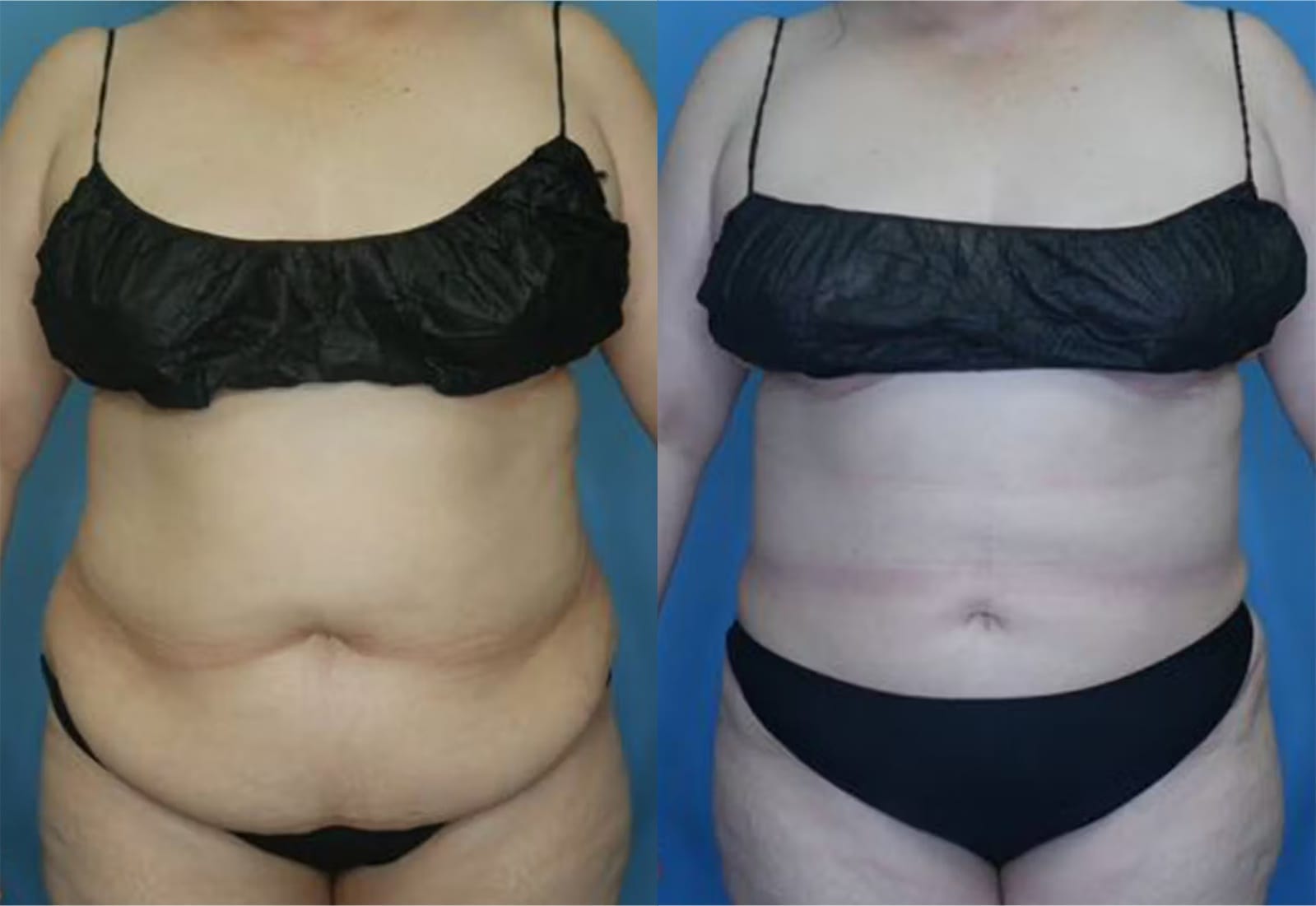Before and After Image: Vaser Liposuction - front