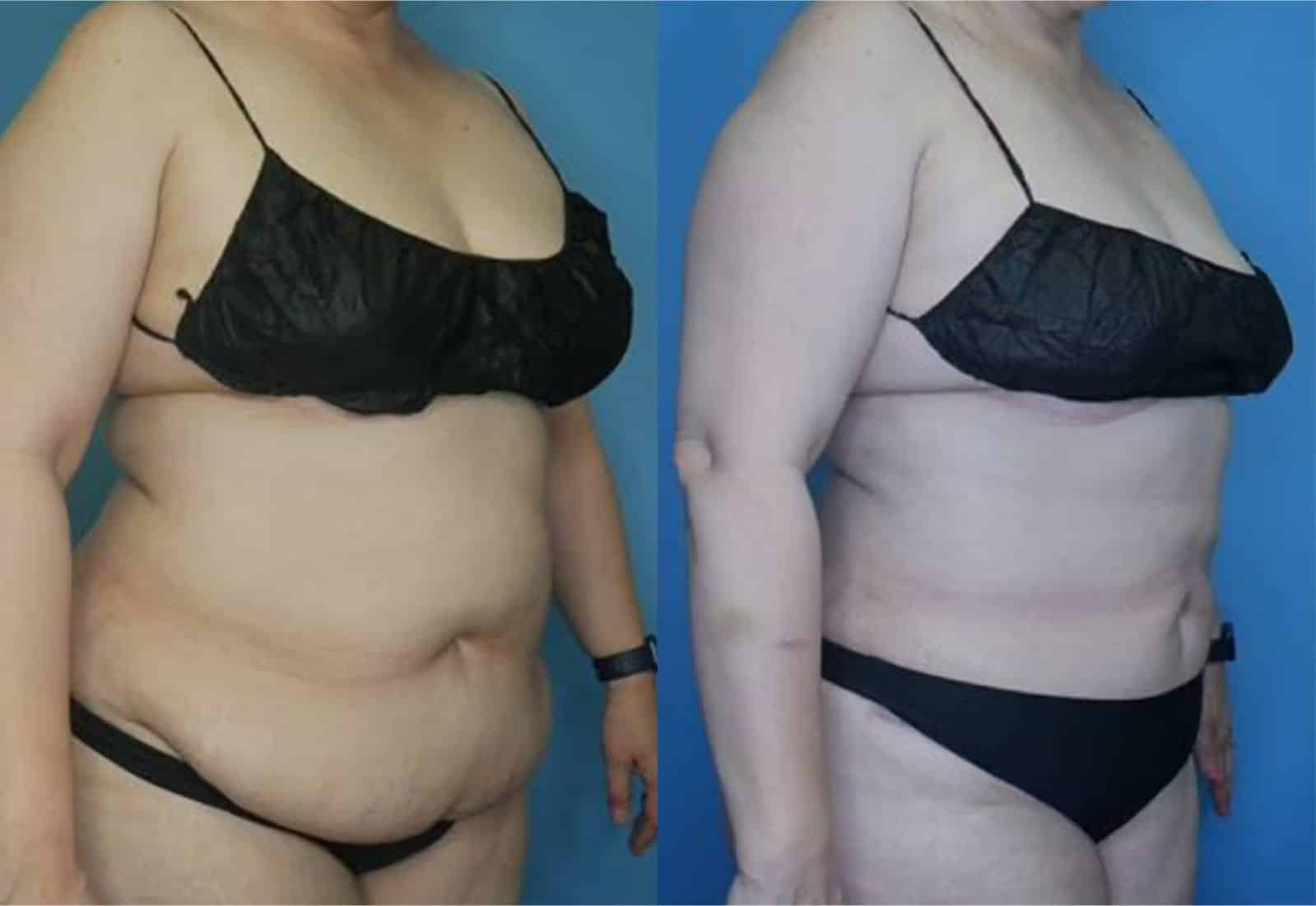 Before and After Image: Vaser Liposuction - right-front-oblique