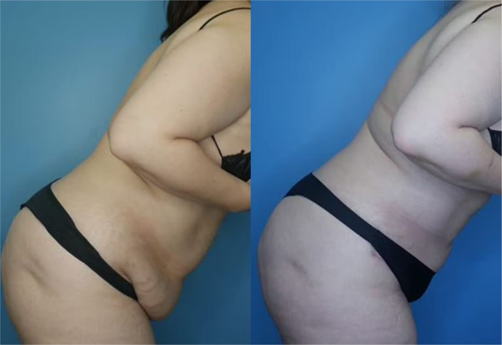 Before and After Image: Vaser Liposuction - other