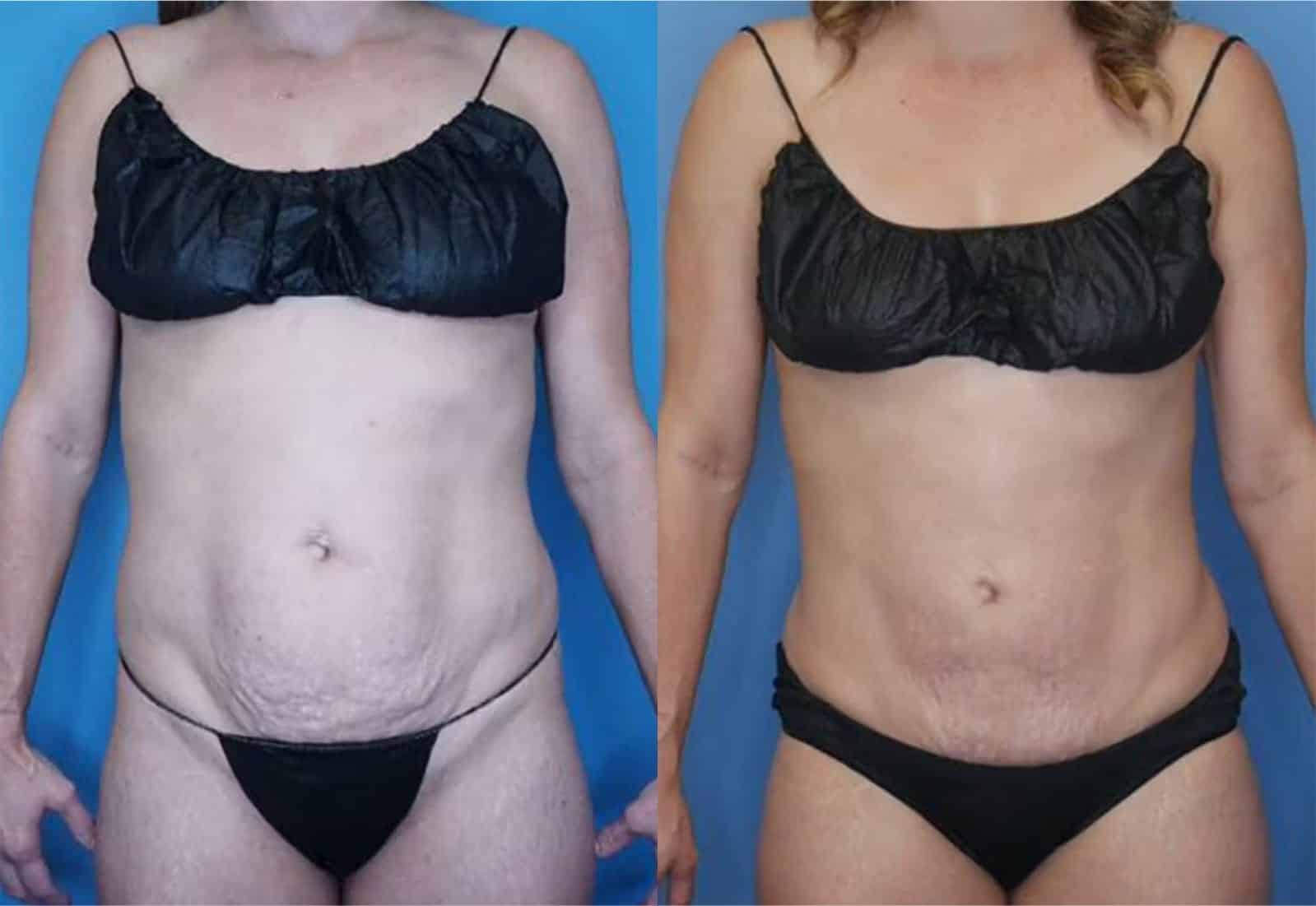 Before and After Image: Vaser Liposuction - front