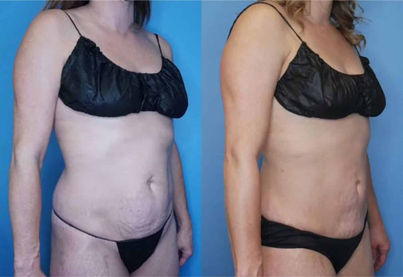 Before and After Image: Vaser Liposuction - right-front-oblique
