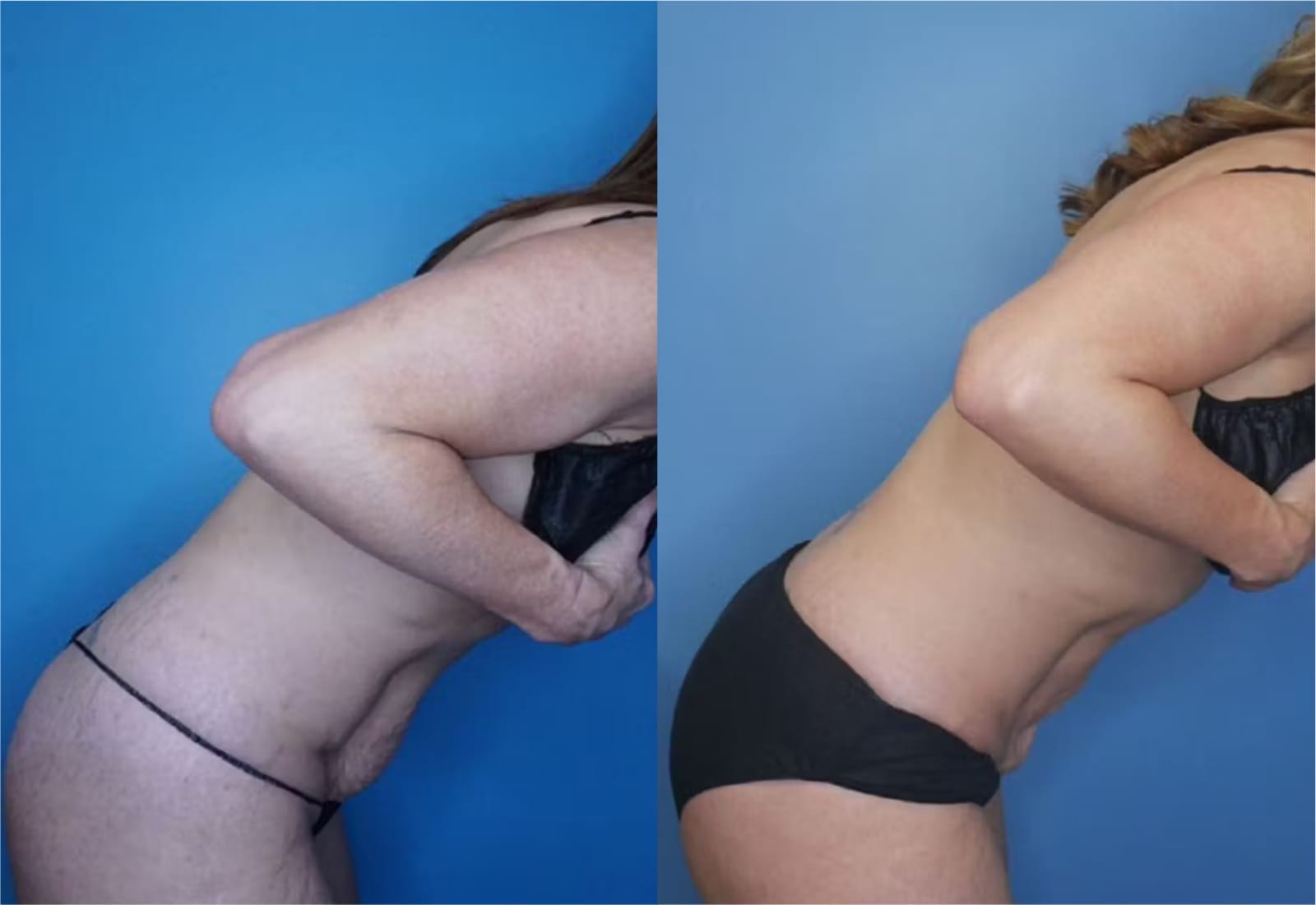 Before and After Image: Vaser Liposuction - other