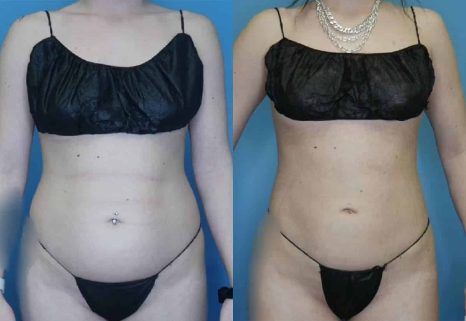 Before and After Image: Vaser Liposuction - front