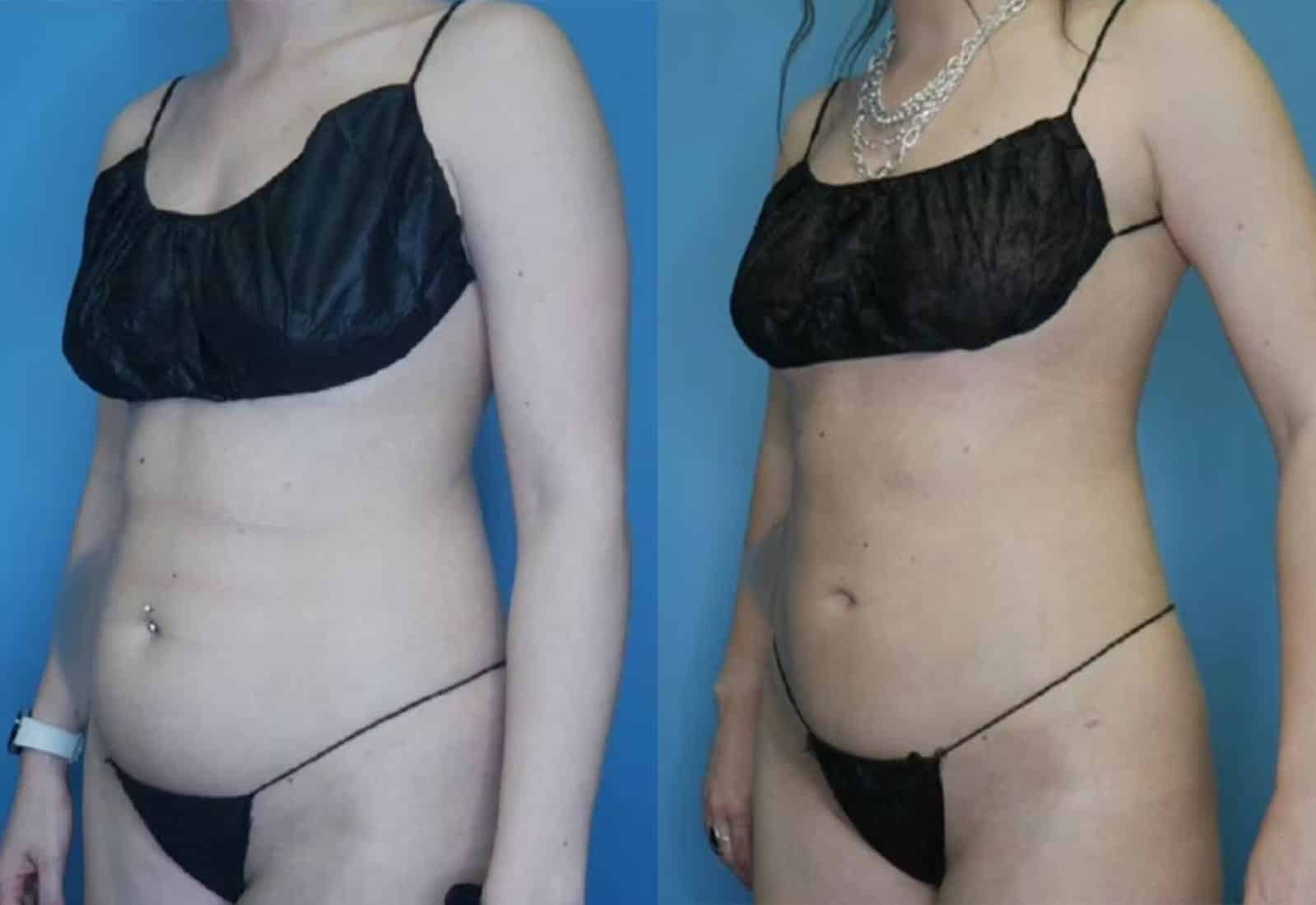 Before and After Image: Vaser Liposuction - left-front-oblique