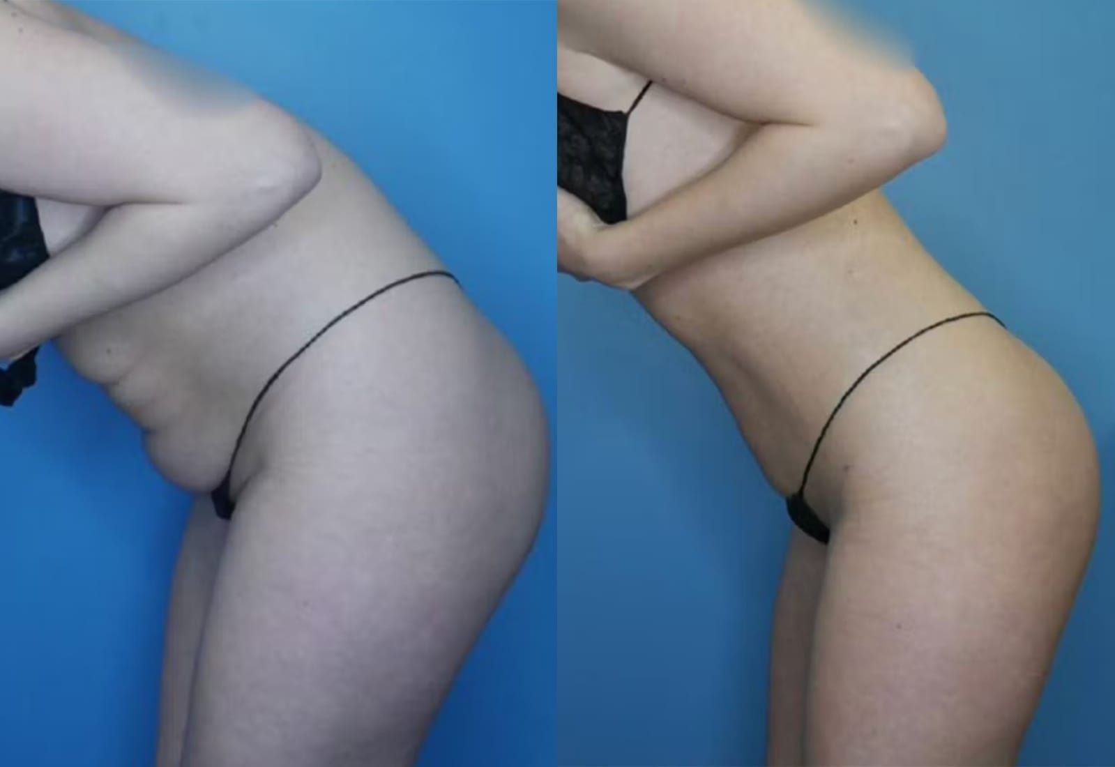 Before and After Image: Vaser Liposuction - other