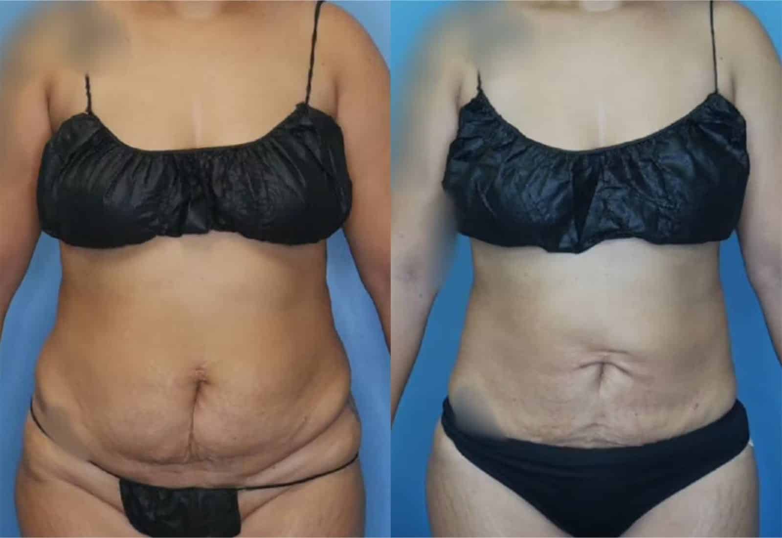 Before and After Image: Vaser Liposuction - front