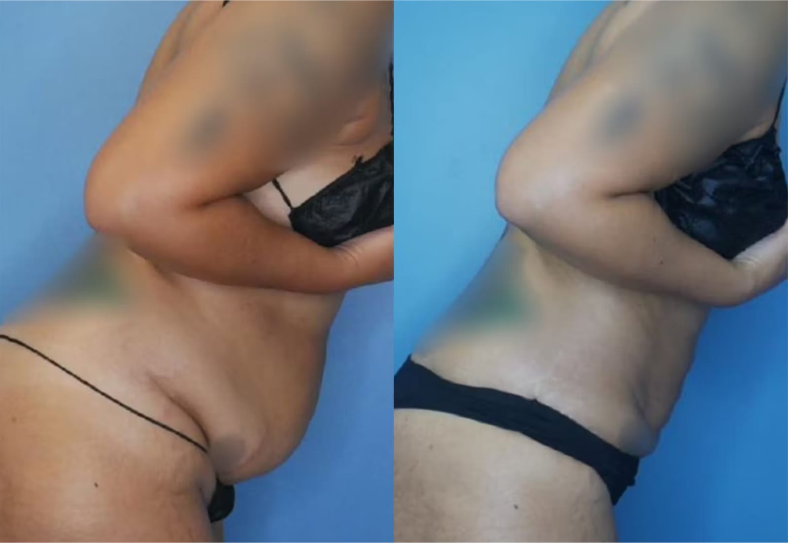 Before and After Image: Vaser Liposuction - other