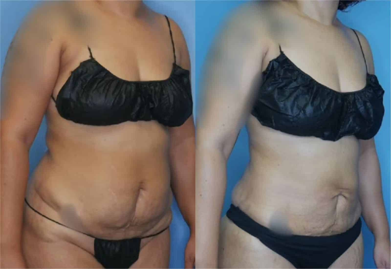 Before and After Image: Vaser Liposuction - right-front-oblique