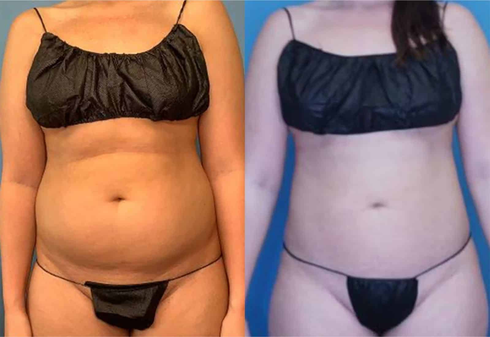 Before and After Image: Vaser Liposuction - front