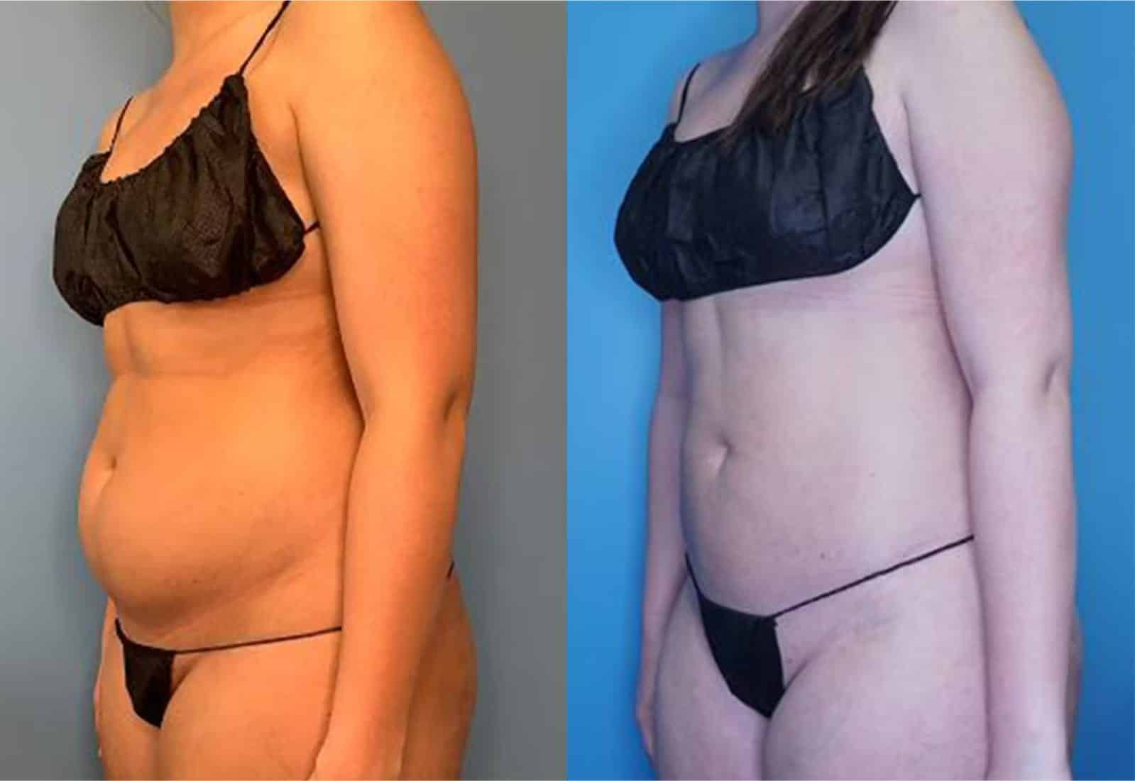 Before and After Image: Vaser Liposuction - left-front-oblique