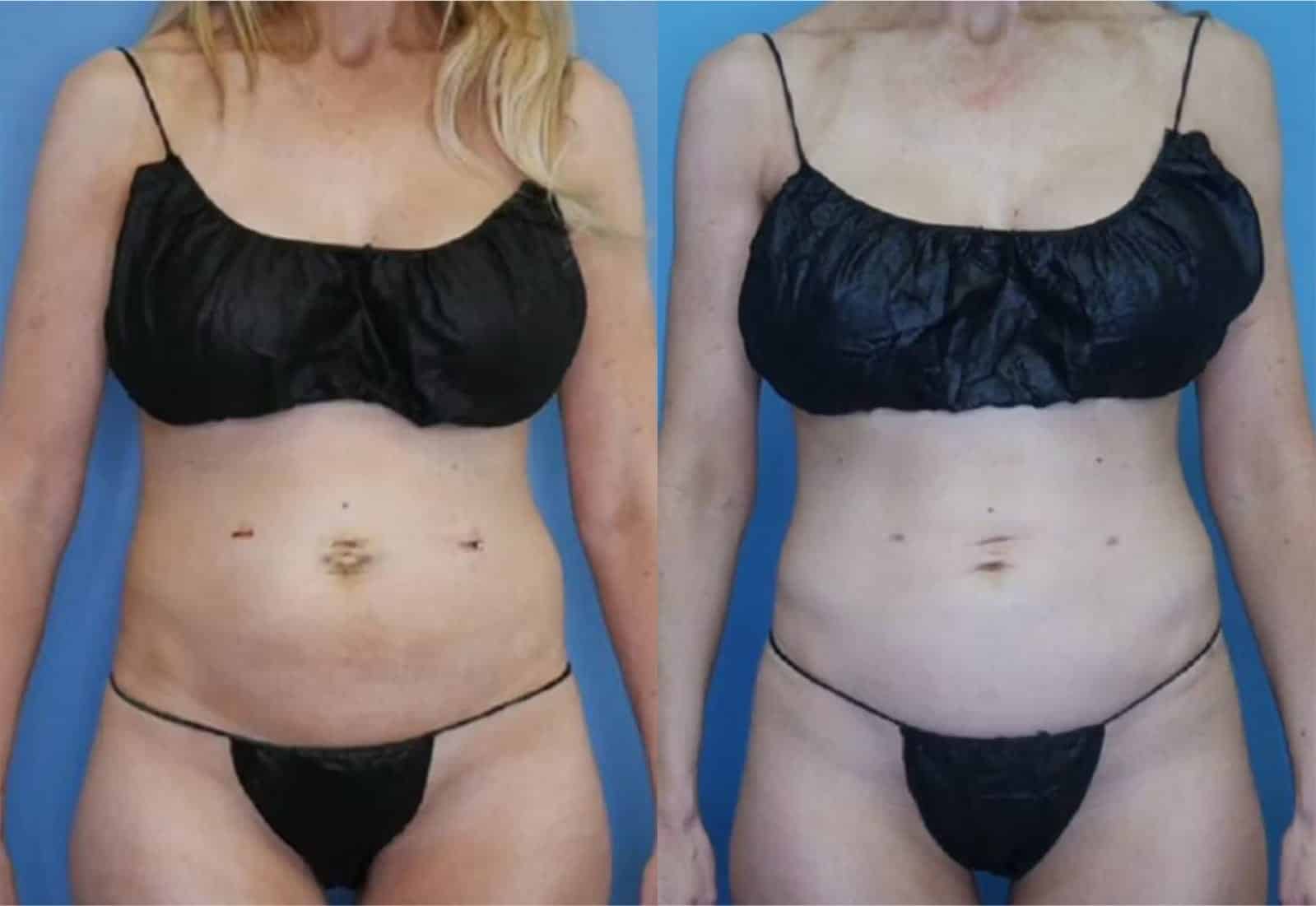 Before and After Image: Vaser Liposuction - front