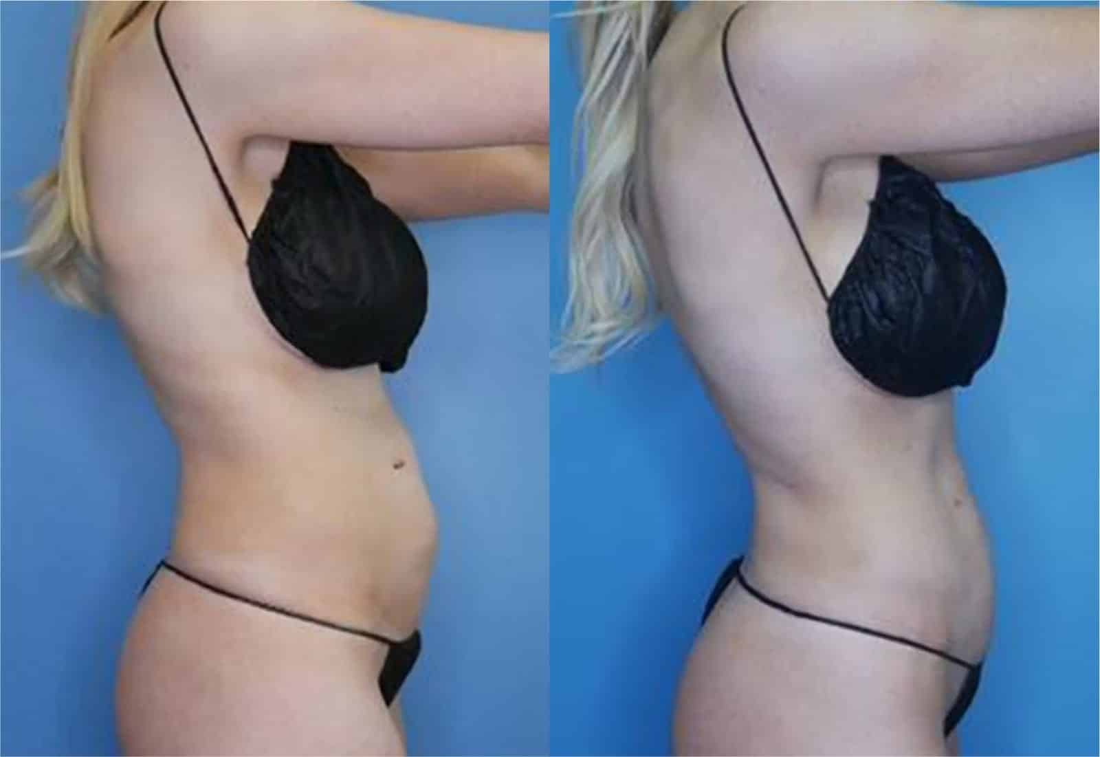 Before and After Image: Vaser Liposuction - right-side