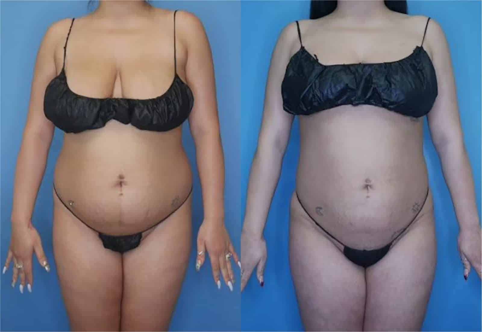 Before and After Image: Vaser Liposuction - front