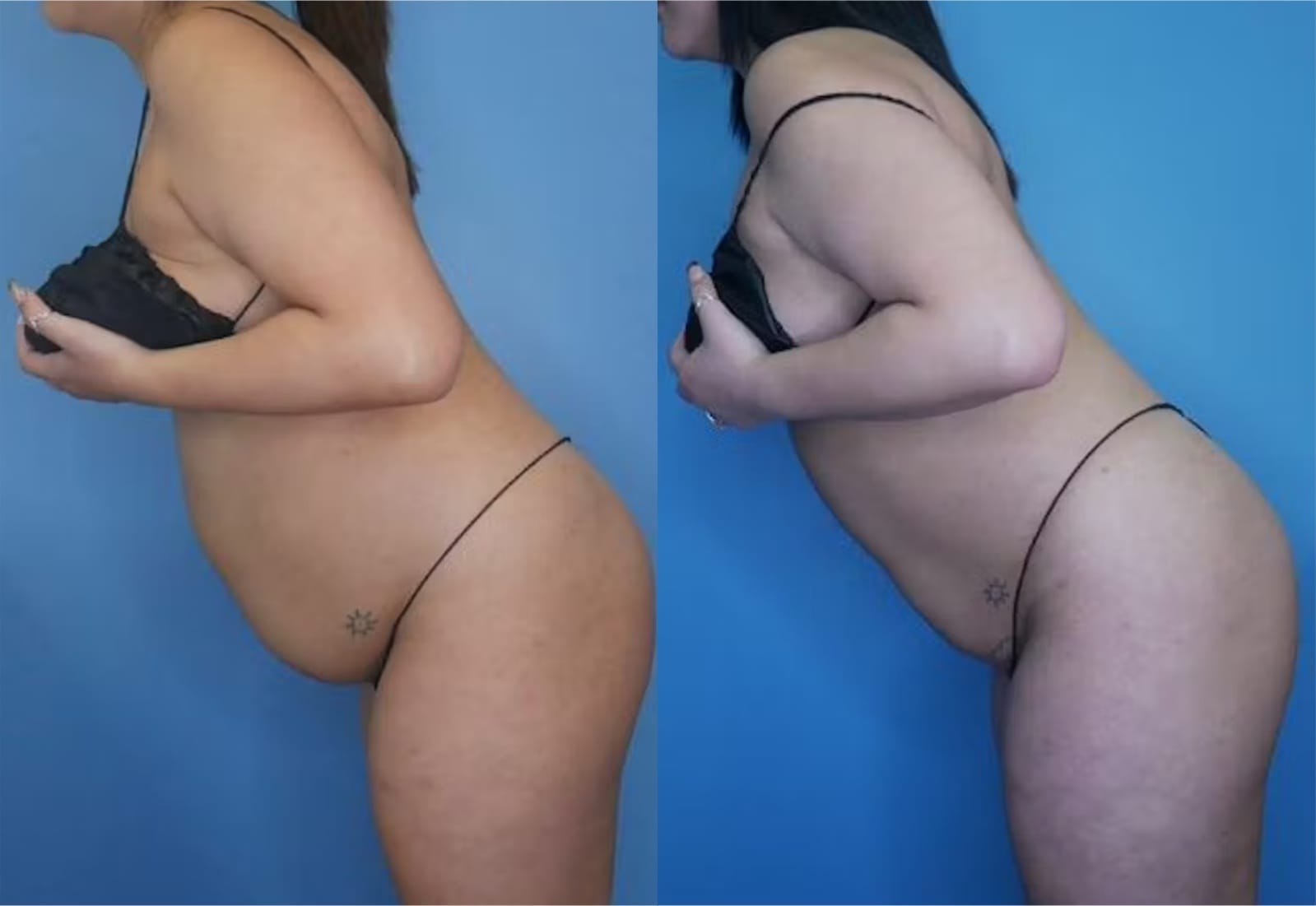 Before and After Image: Vaser Liposuction - other