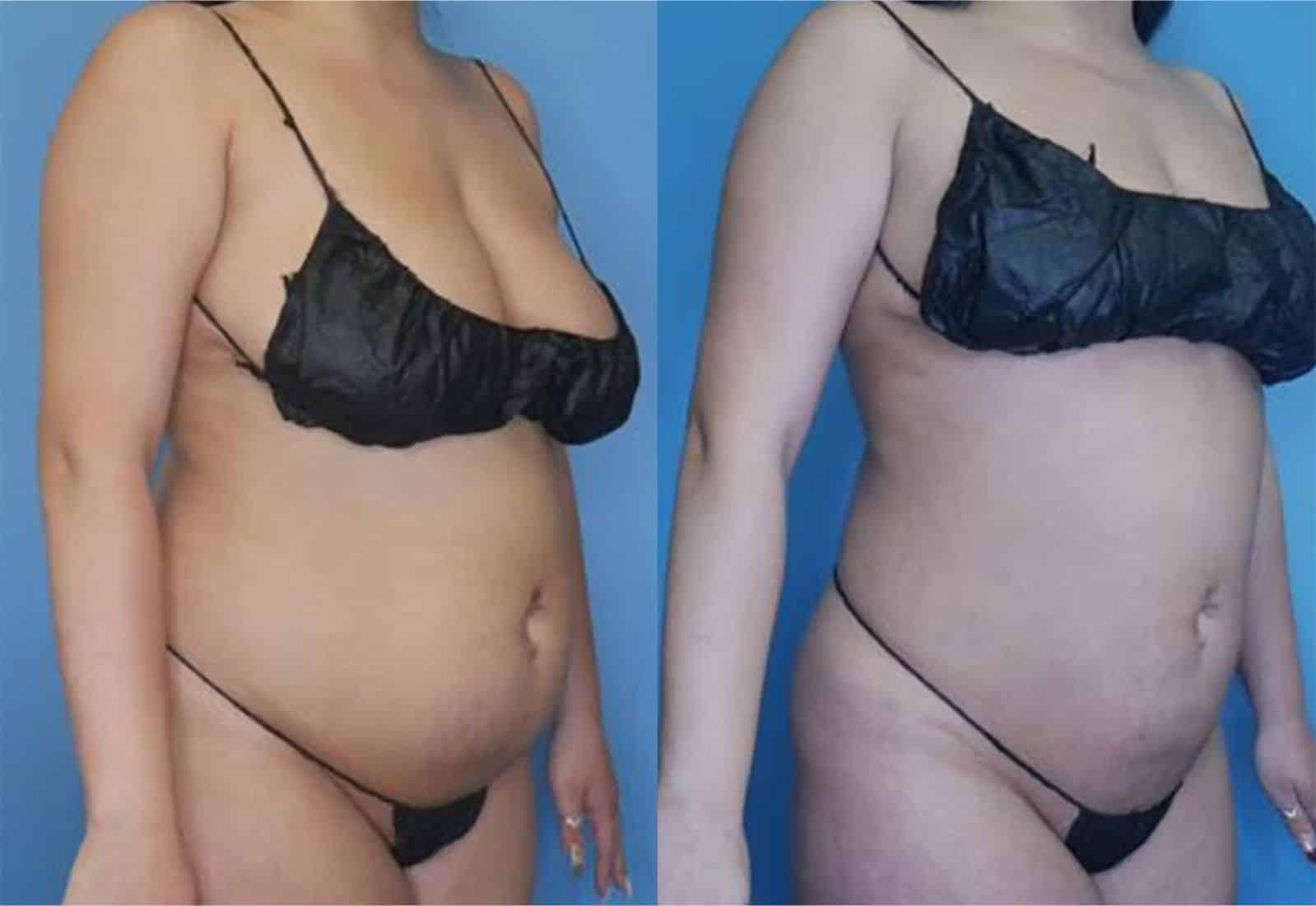 Before and After Image: Vaser Liposuction - right-front-oblique