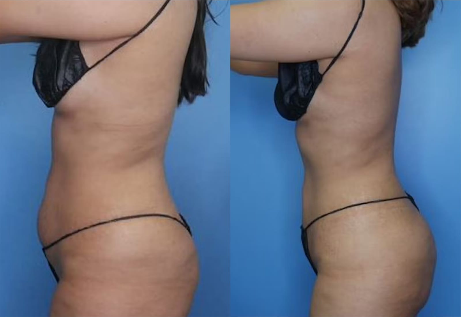 Before and After Image: Vaser Liposuction - left-side