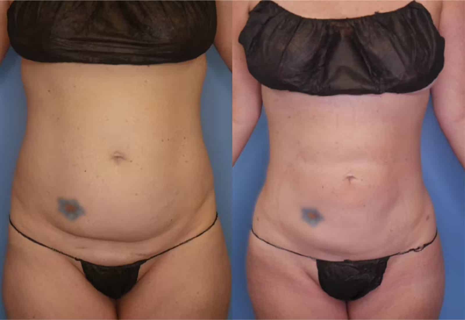 Before and After Image: Vaser Liposuction - front