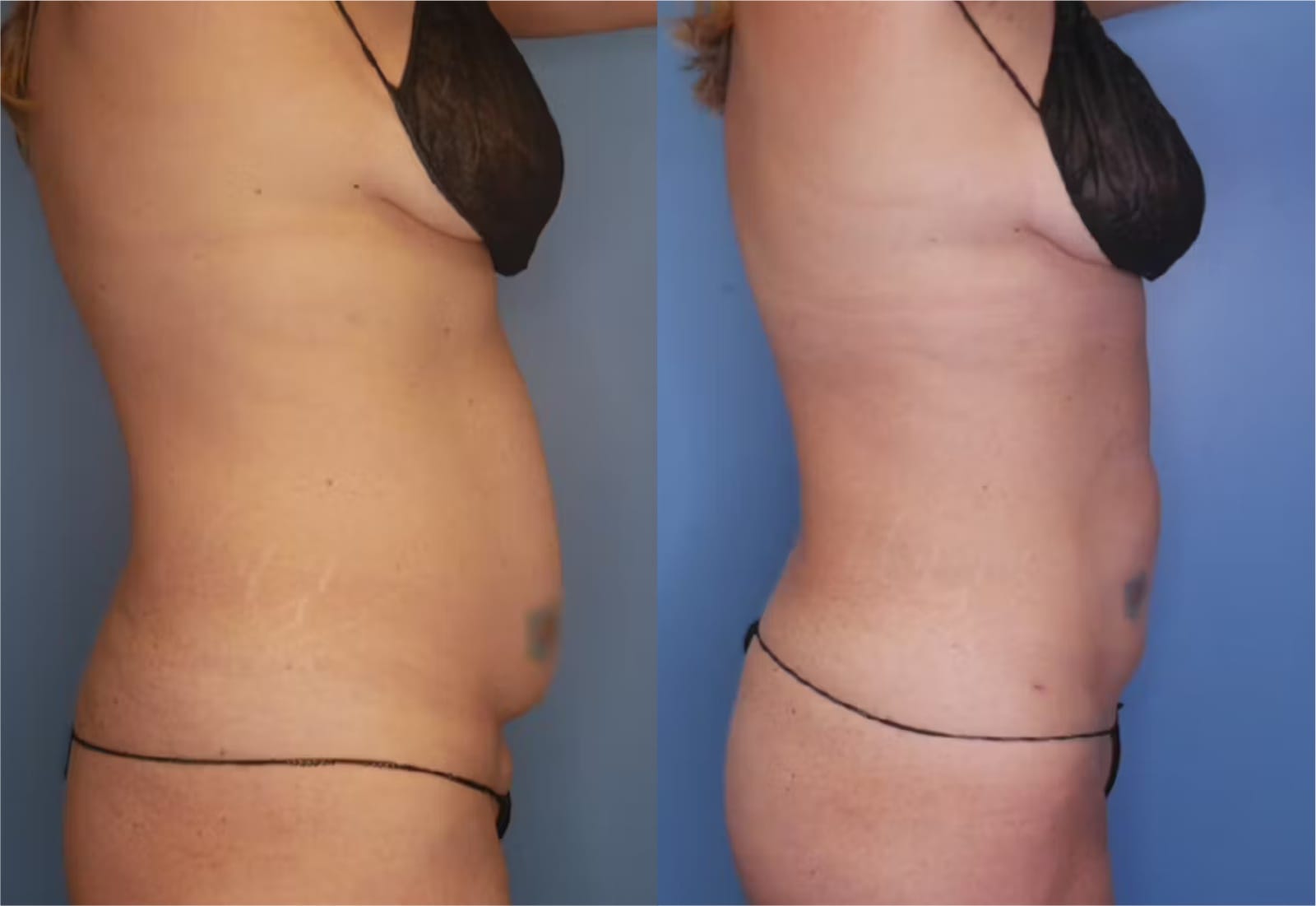 Before and After Image: Vaser Liposuction - right-side