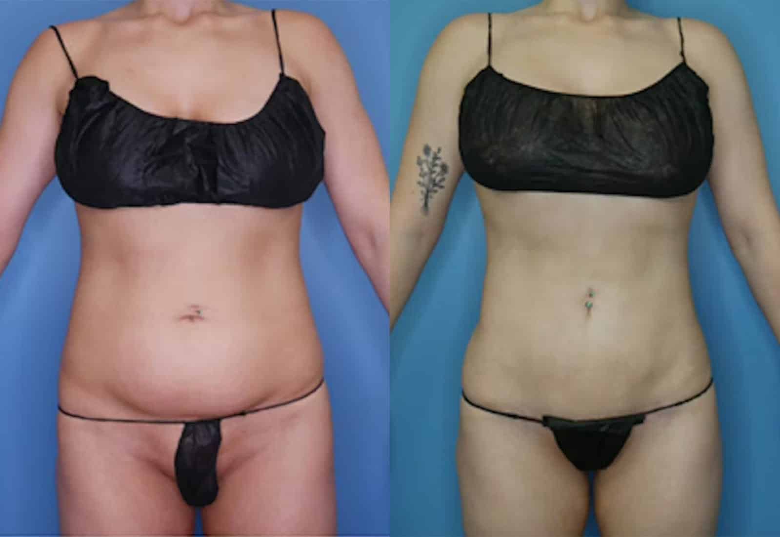 Before and After Image: Vaser Liposuction - front
