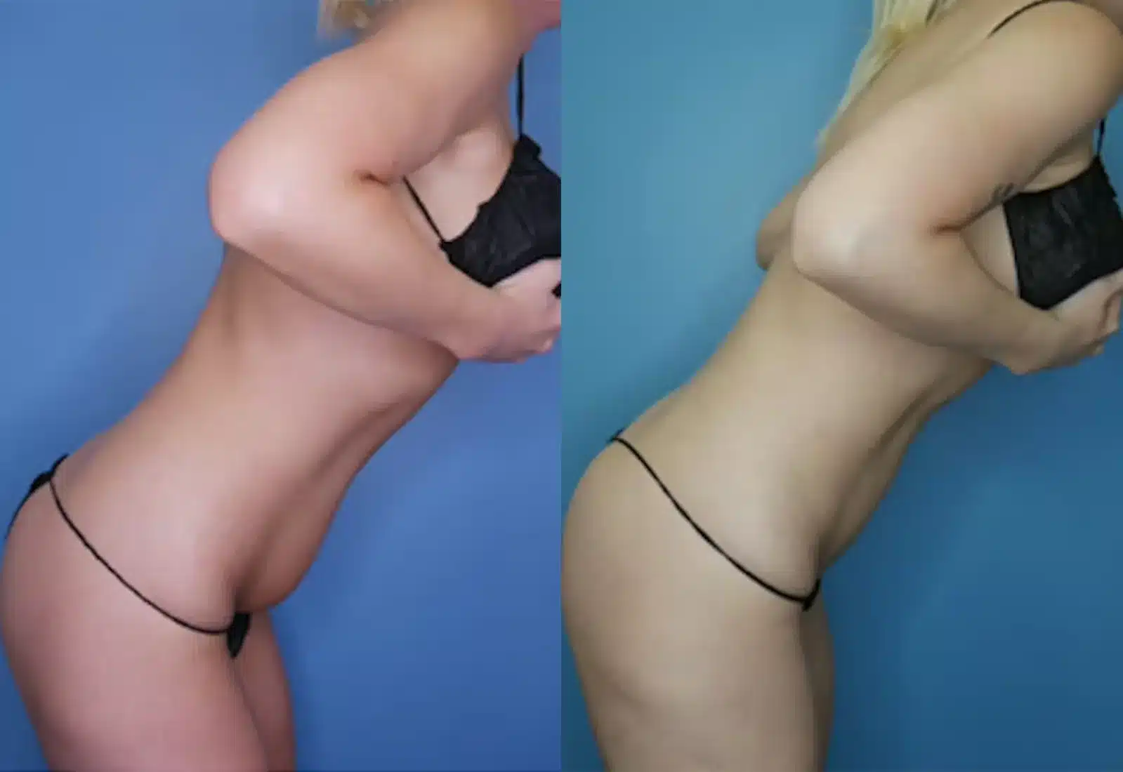 Before and After Image: Vaser Liposuction - other