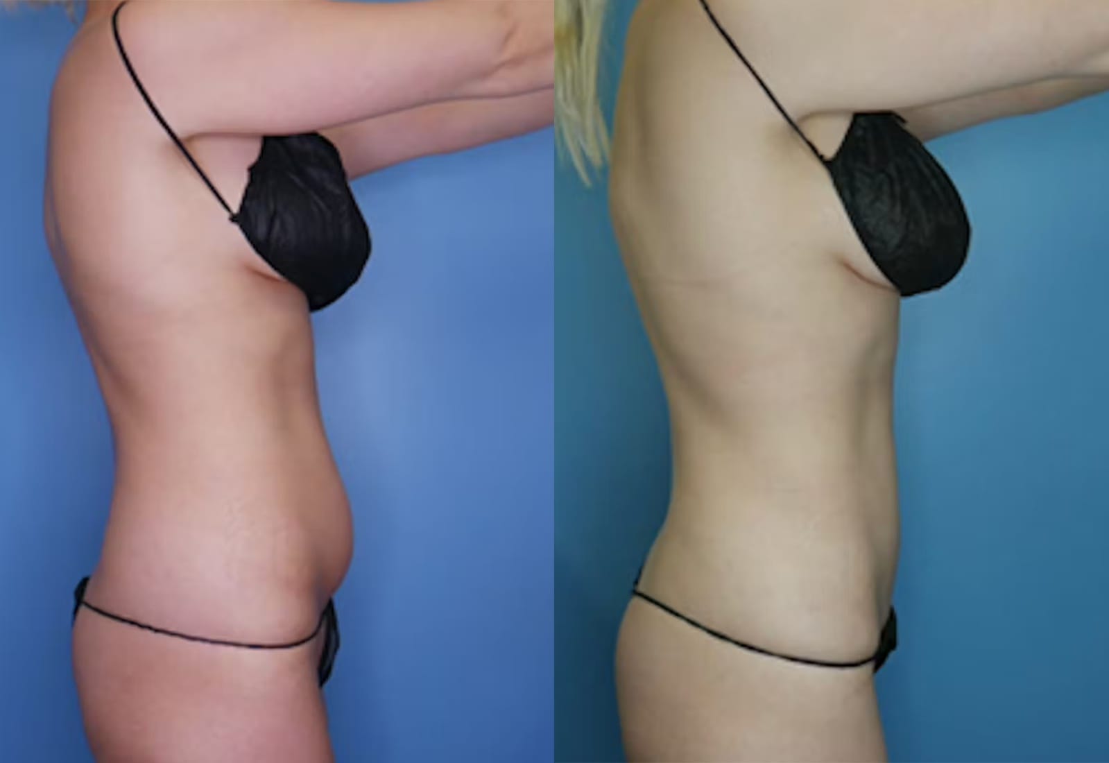 Before and After Image: Vaser Liposuction - right-side