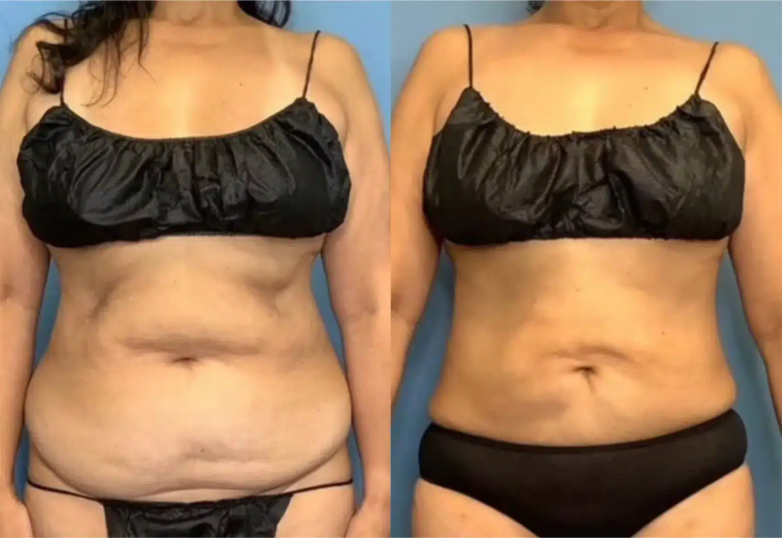 Before and After Image: Vaser Liposuction - front