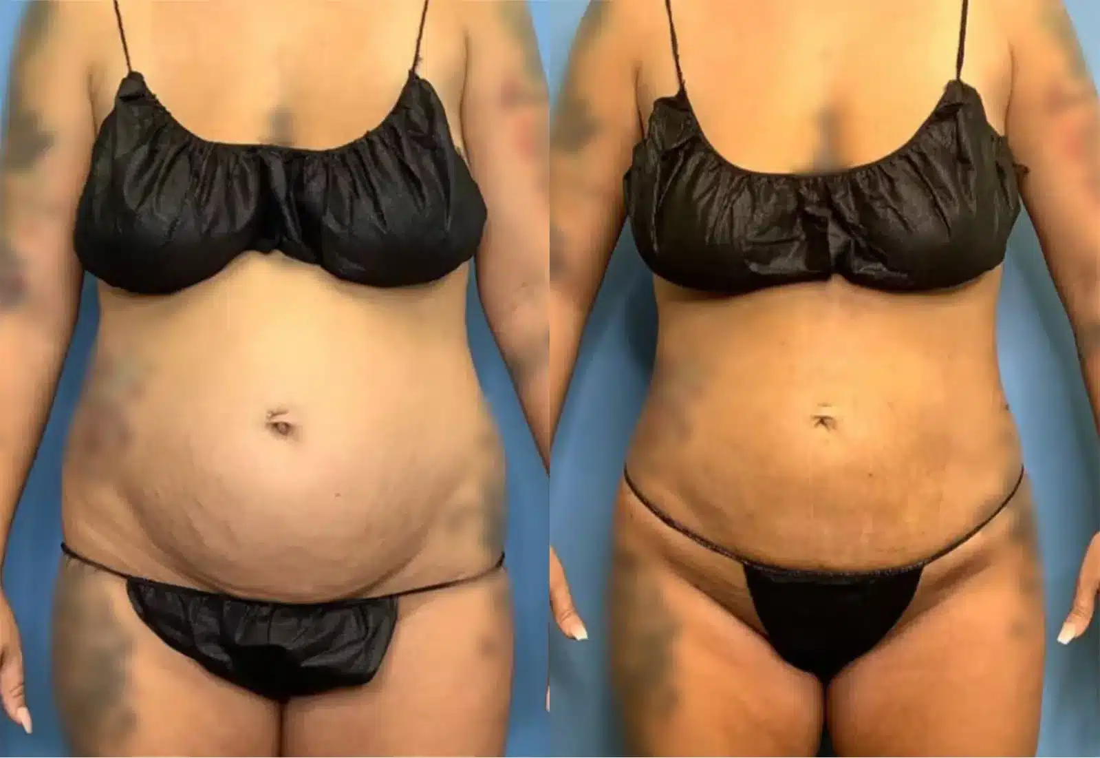 Before and After Image: Vaser Liposuction - front