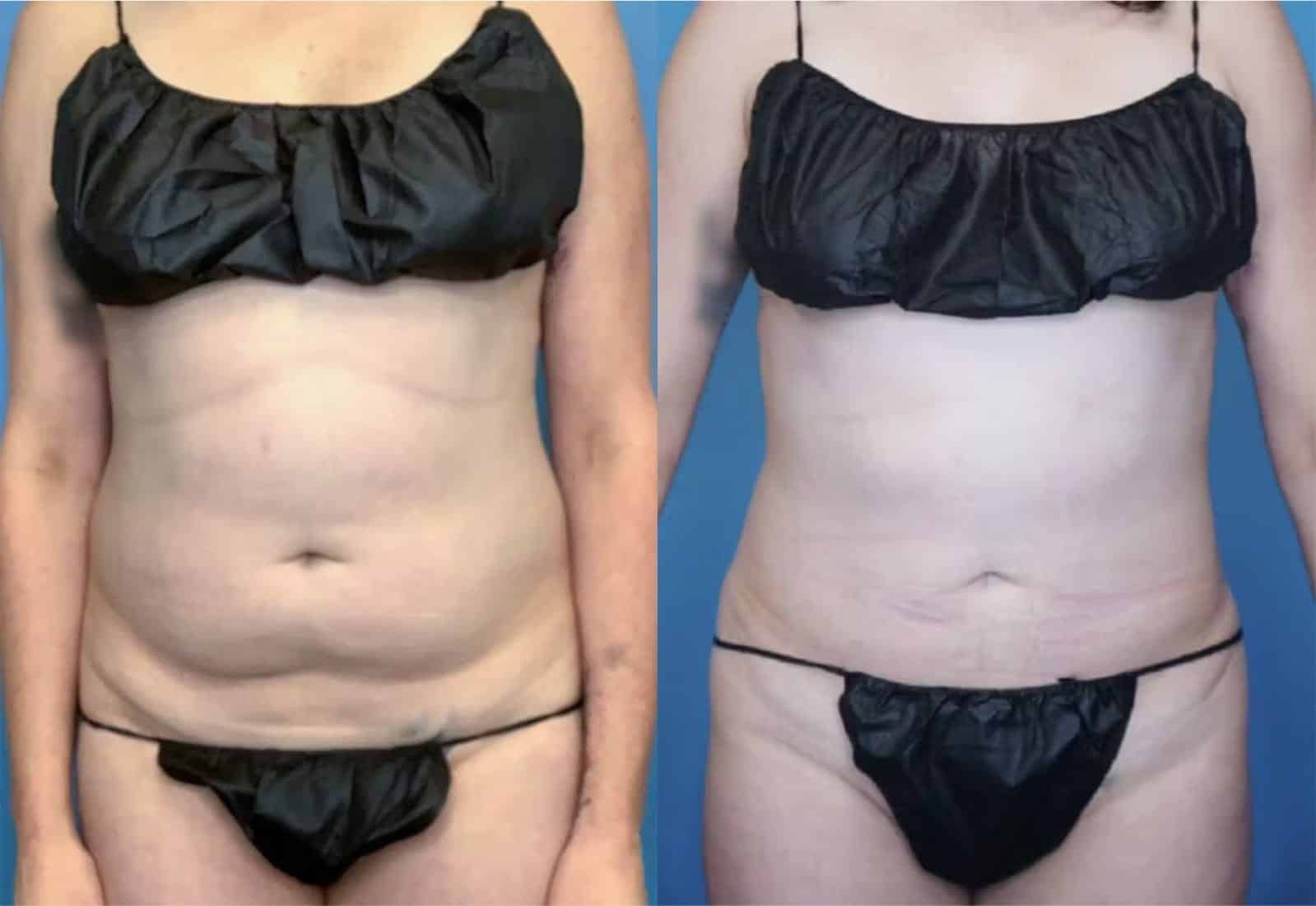 Before and After Image: Vaser Liposuction - front