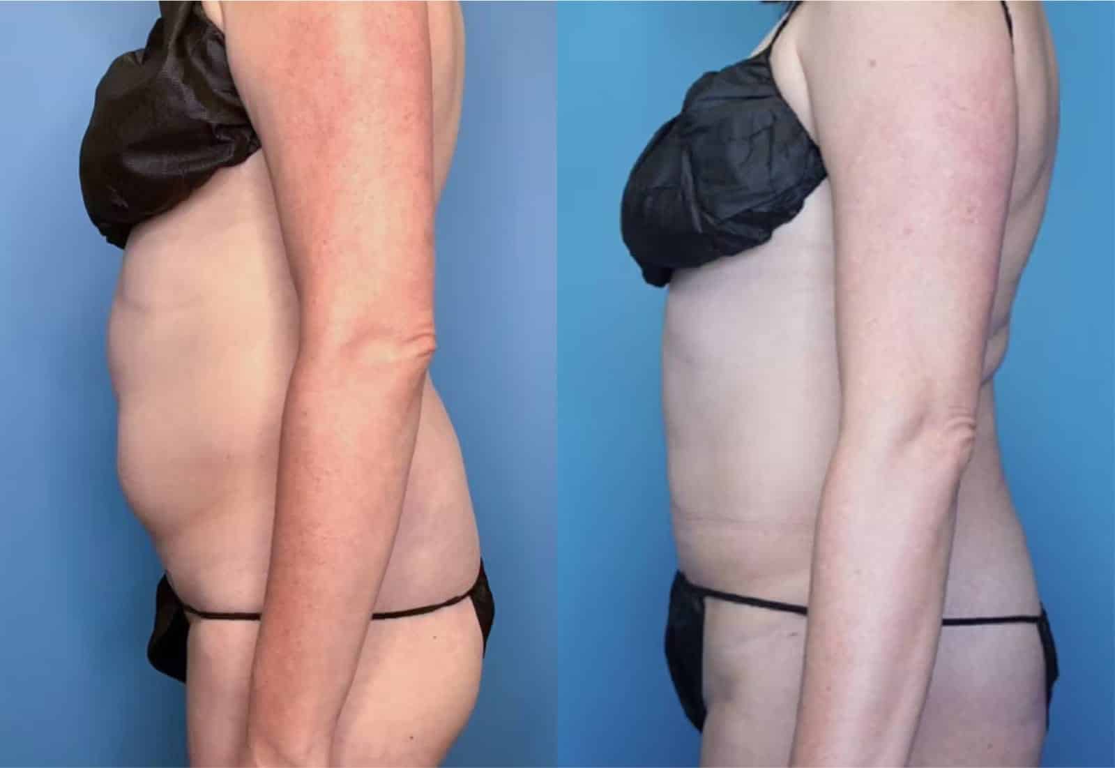 Before and After Image: Vaser Liposuction - left-side