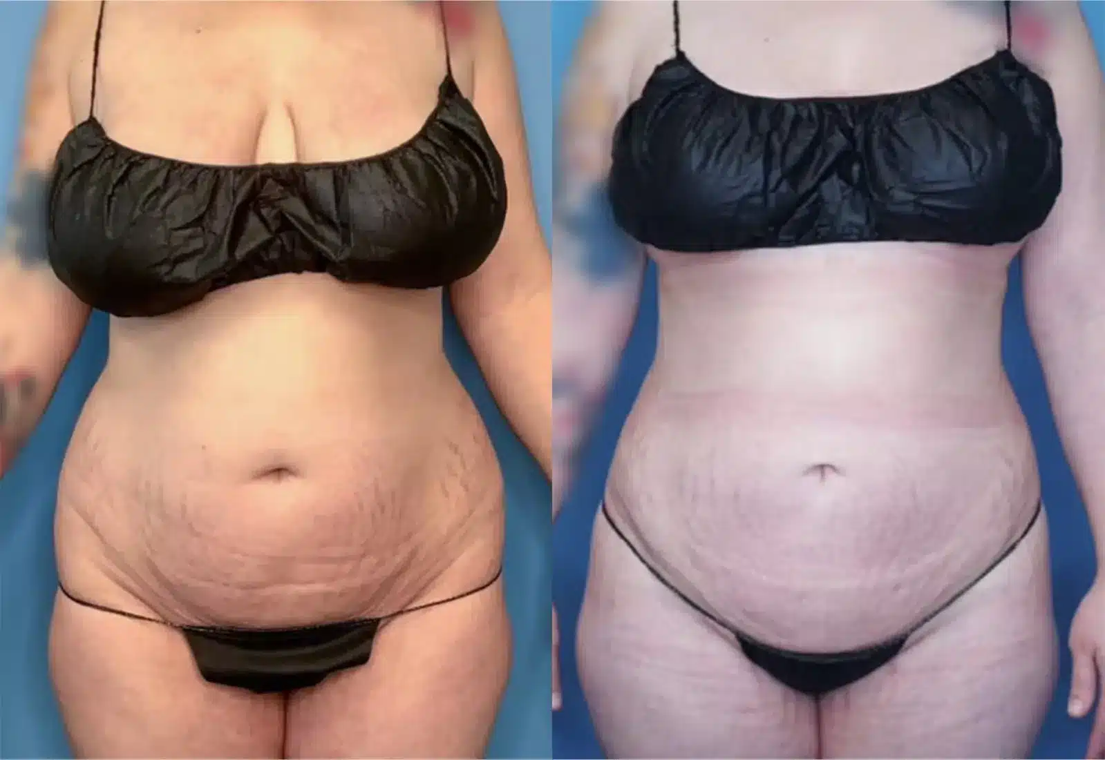Before and After Image: Vaser Liposuction - front