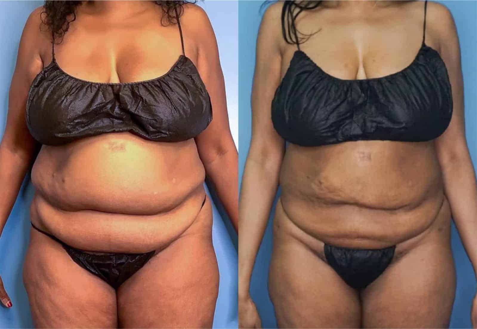Before and After Image: Vaser Liposuction - front