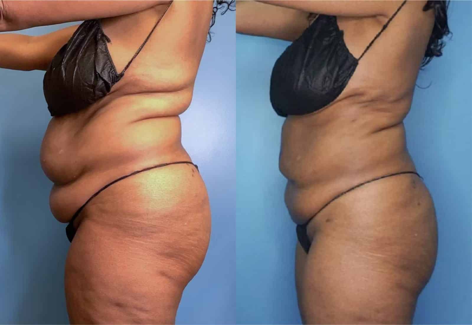 Before and After Image: Vaser Liposuction - left-side