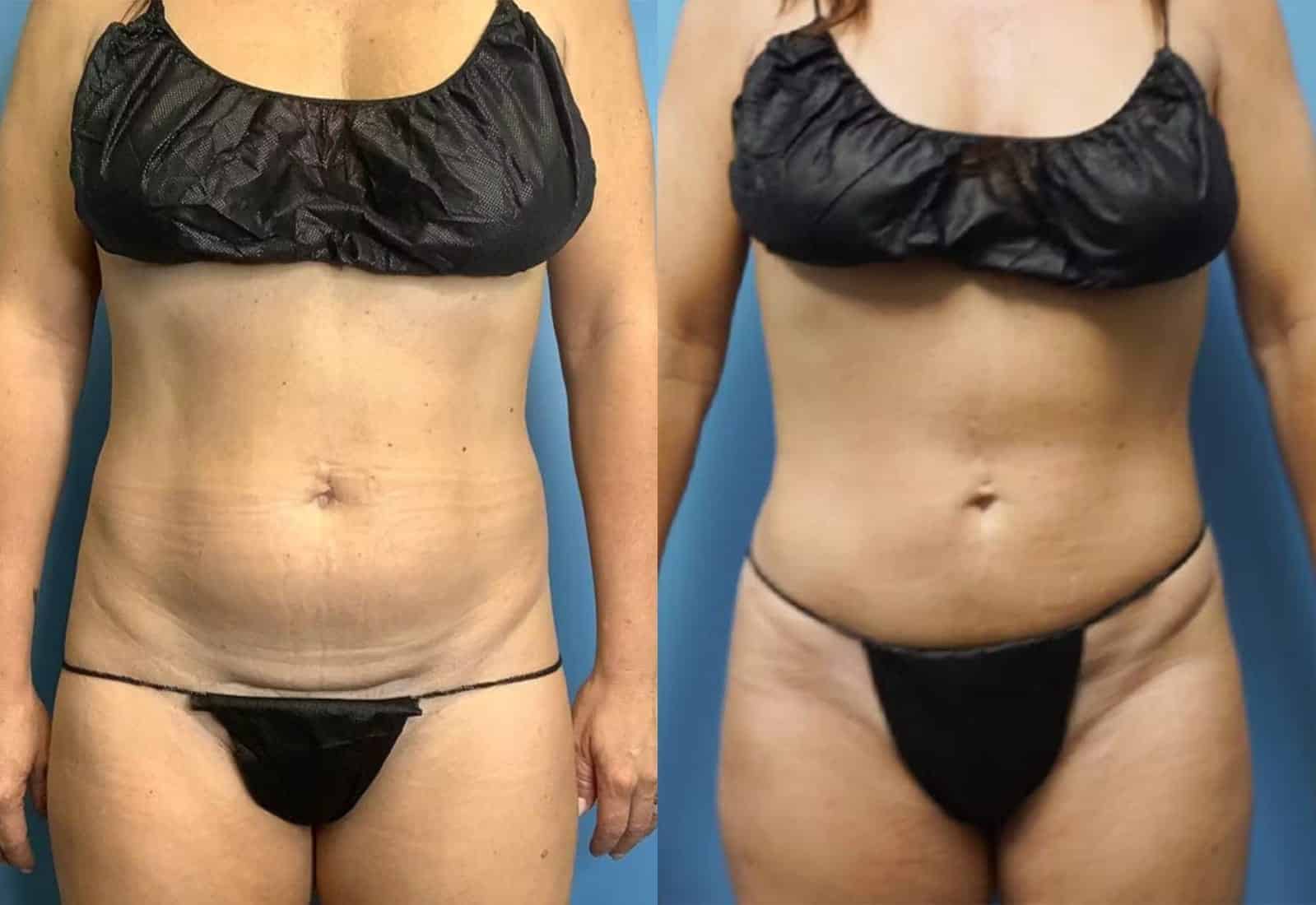 Before and After Image: Vaser Liposuction - front