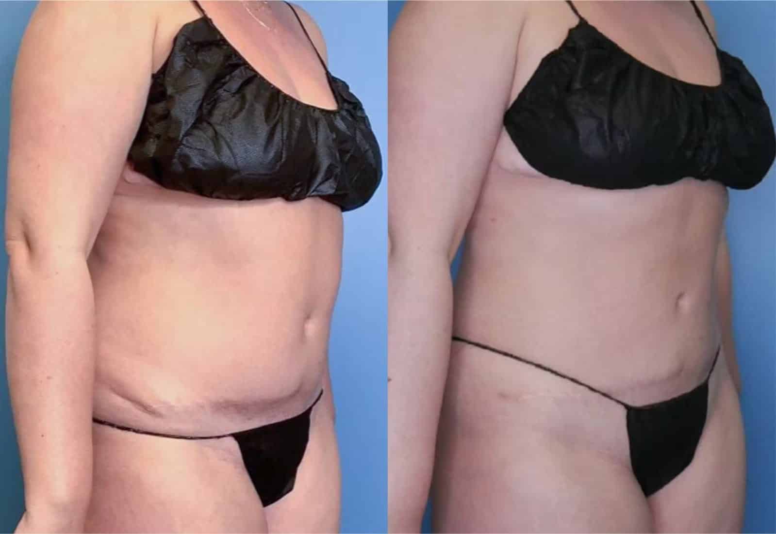 Before and After Image: Vaser Liposuction - right-front-oblique