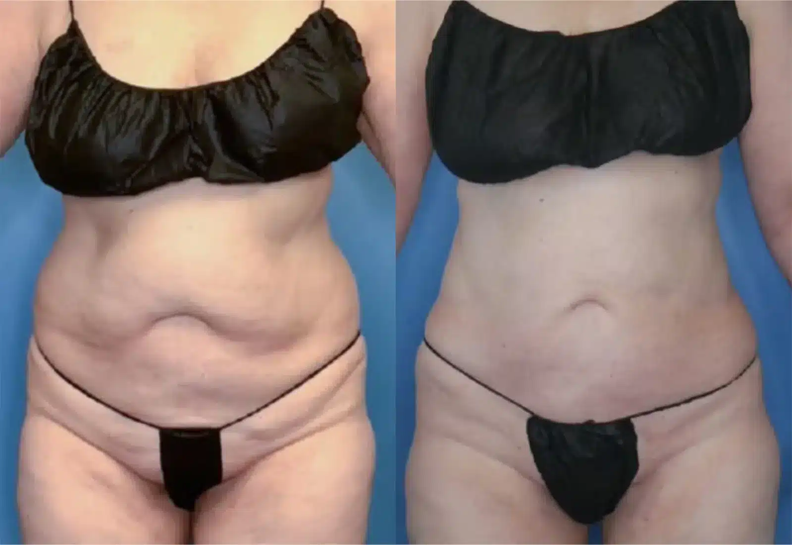 Before and After Image: Vaser Liposuction - front
