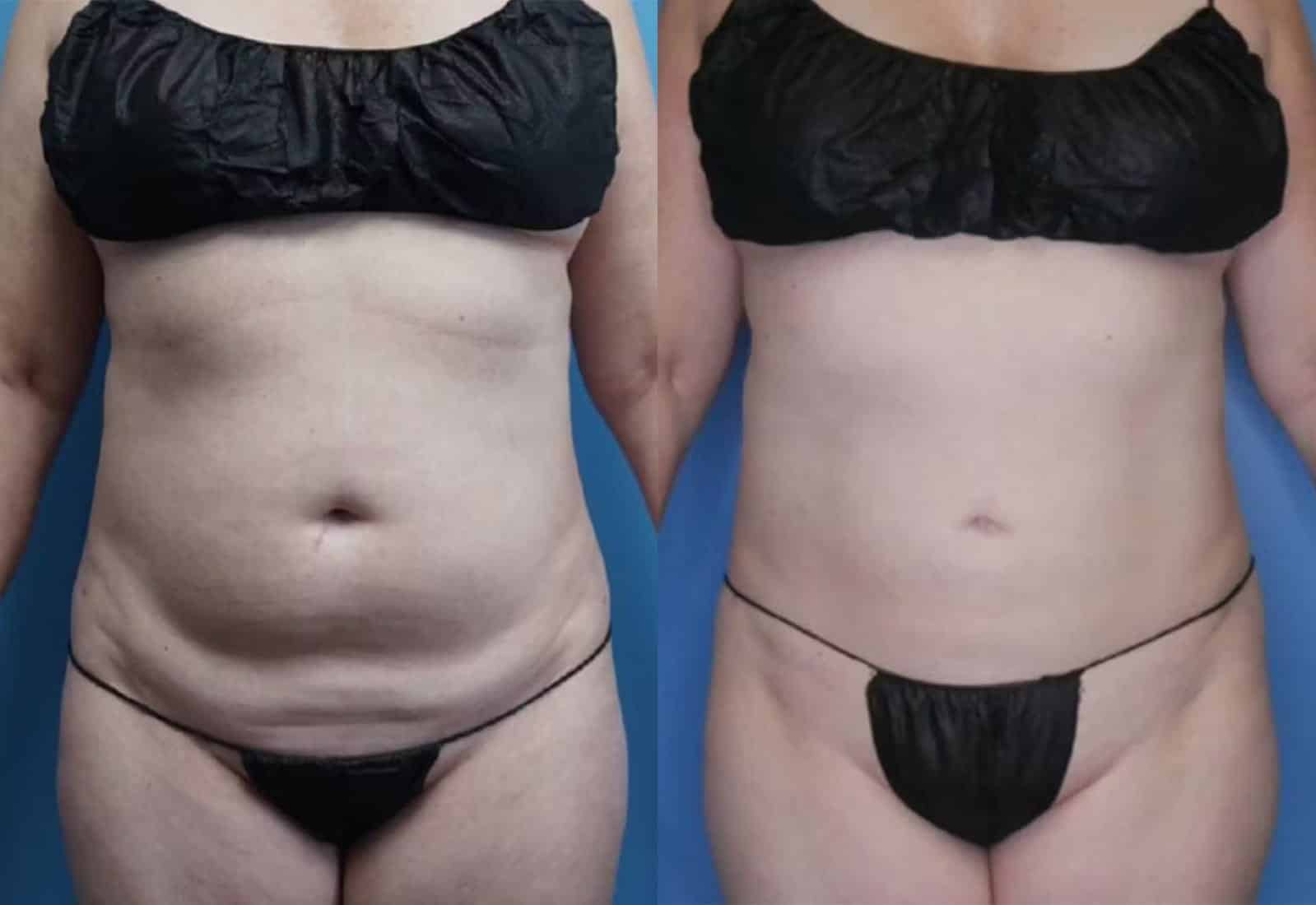 Before and After Image: Vaser Liposuction - front