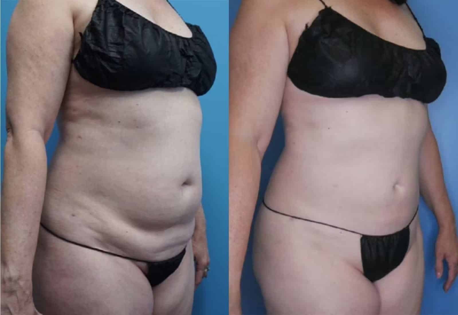 Before and After Image: Vaser Liposuction - right-front-oblique