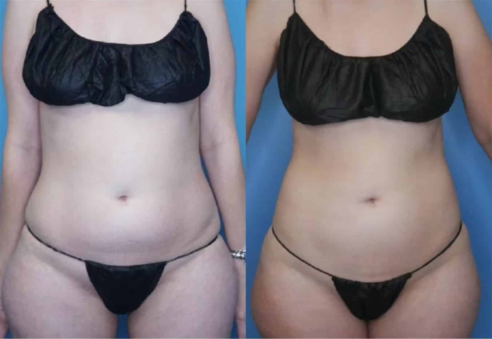 Before and After Image: Vaser Liposuction - front