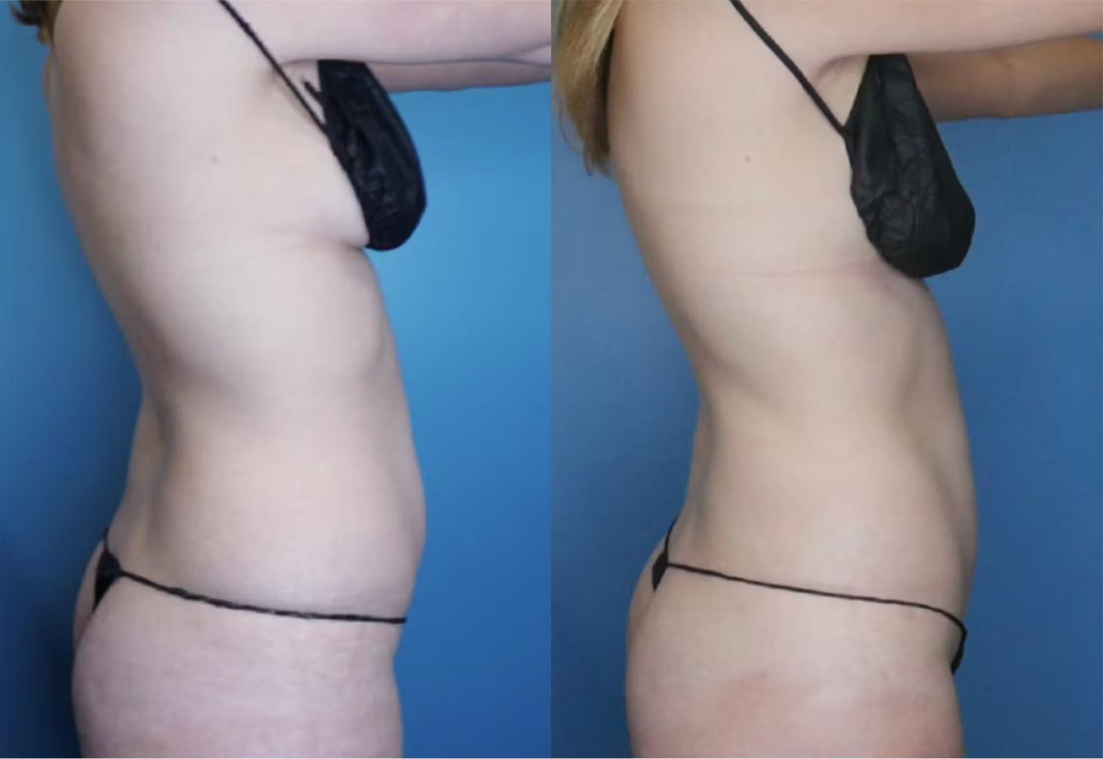 Before and After Image: Vaser Liposuction - right-side