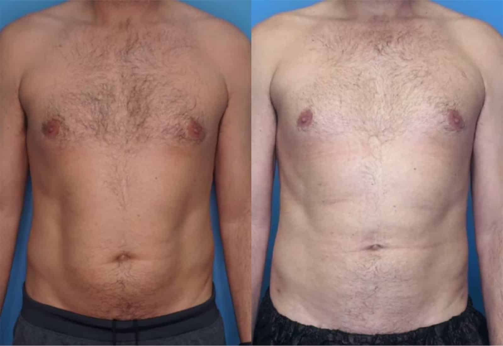 Before and After Image: Vaser Liposuction - front