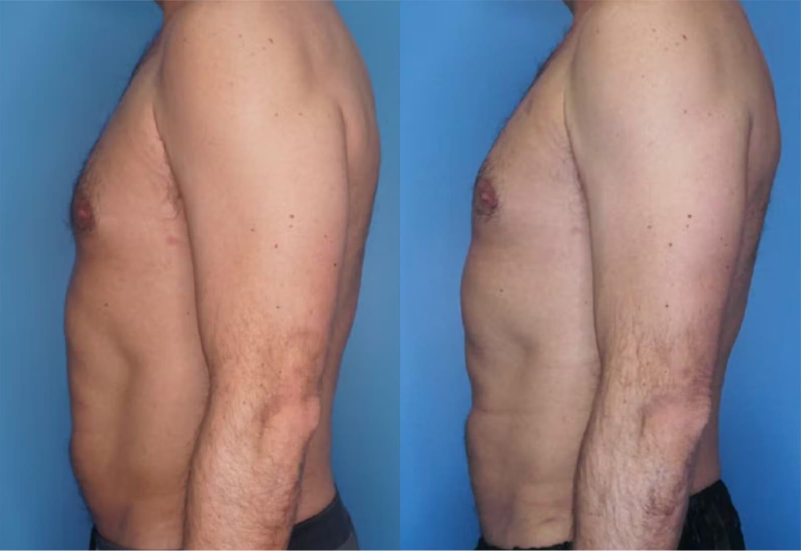 Before and After Image: Vaser Liposuction - left-side