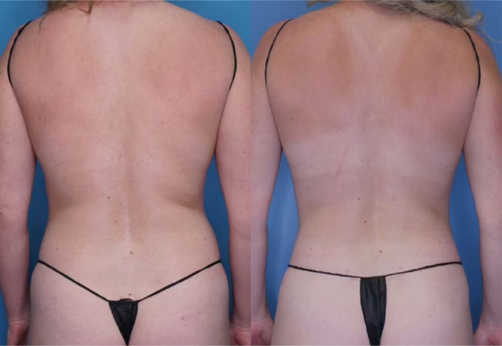 Before and After Image: Vaser Liposuction - back