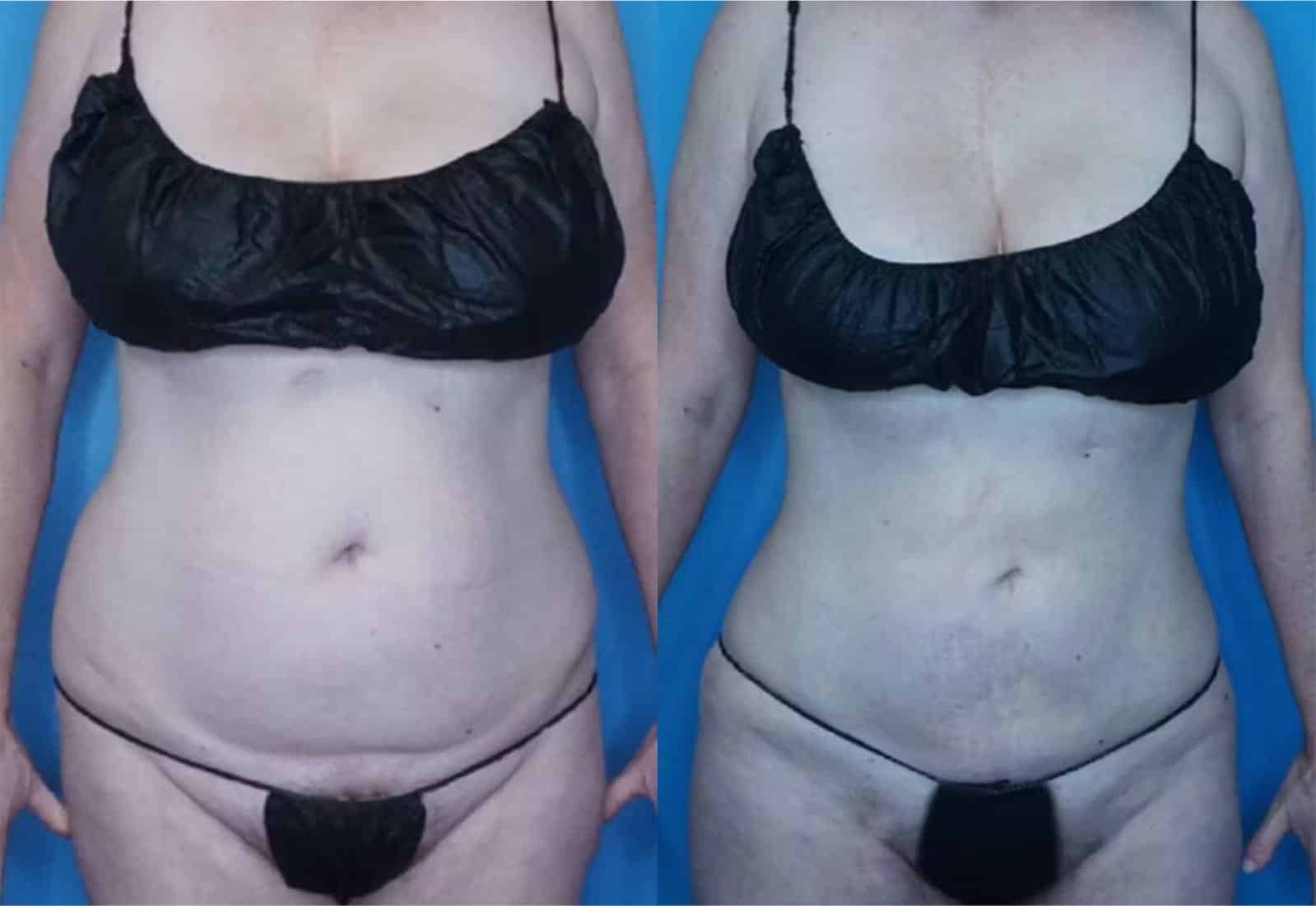 Before and After Image: Vaser Liposuction - front