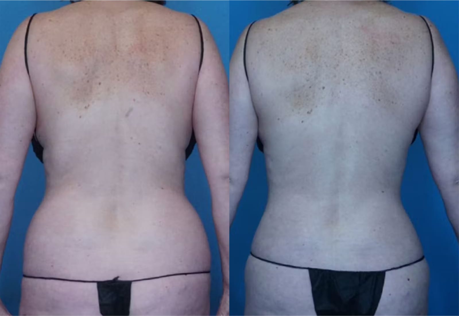 Before and After Image: Vaser Liposuction - back