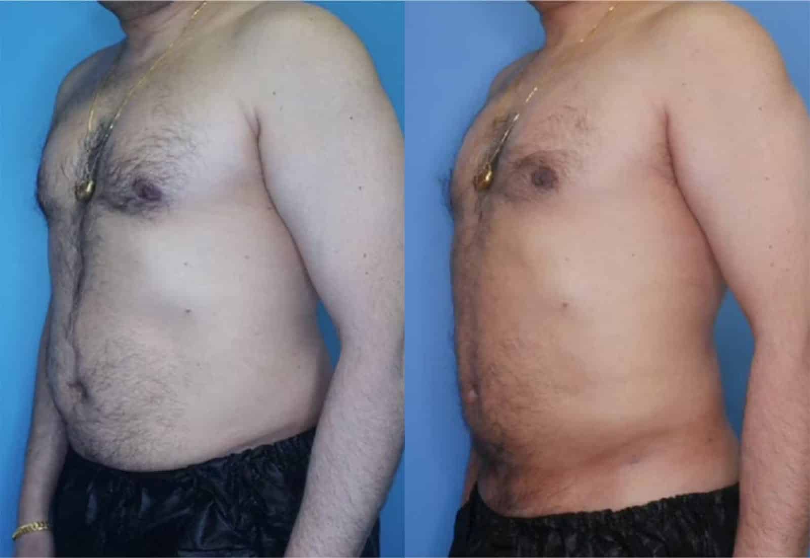 Before and After Image: Vaser Liposuction - left-front-oblique
