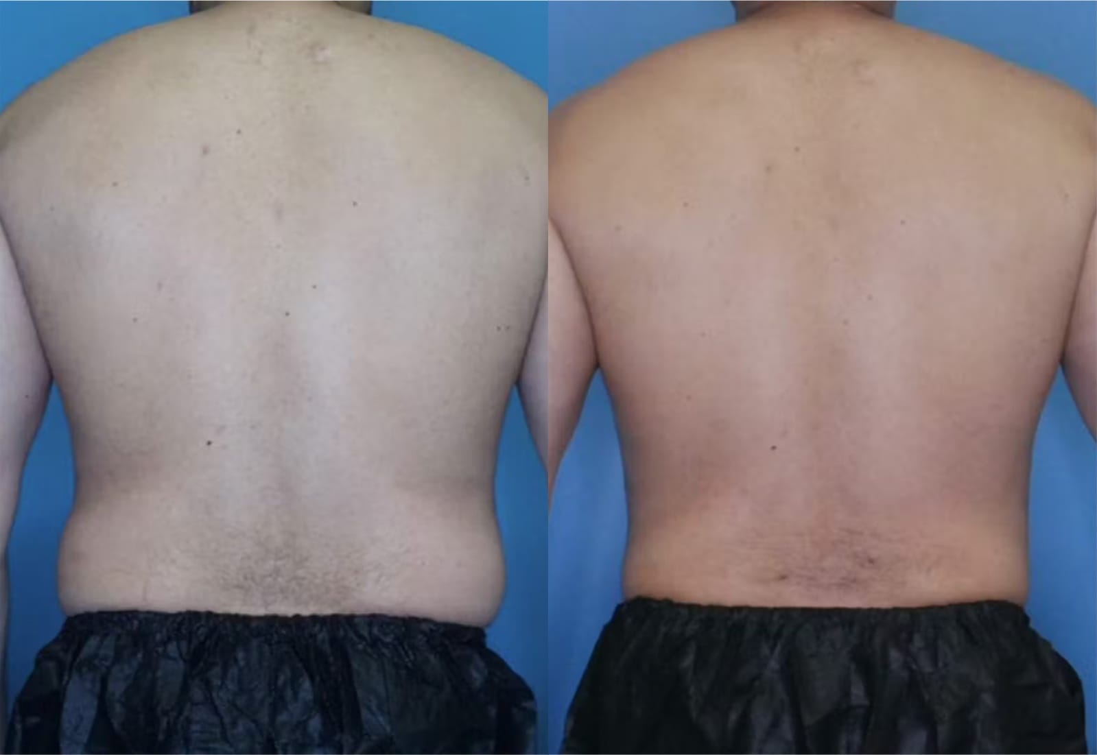 Before and After Image: Vaser Liposuction - back
