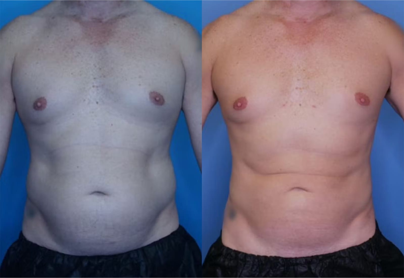 Before and After Image: Vaser Liposuction - front