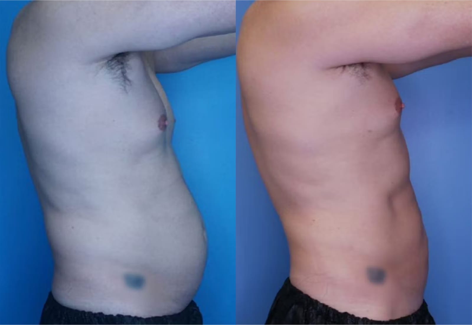 Before and After Image: Vaser Liposuction - right-side